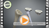 medizinische animation inverse schulterprothese