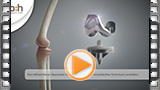 medizinische animation knie totalendoprothese
