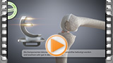 medizinische animation oxford schlittenprothese